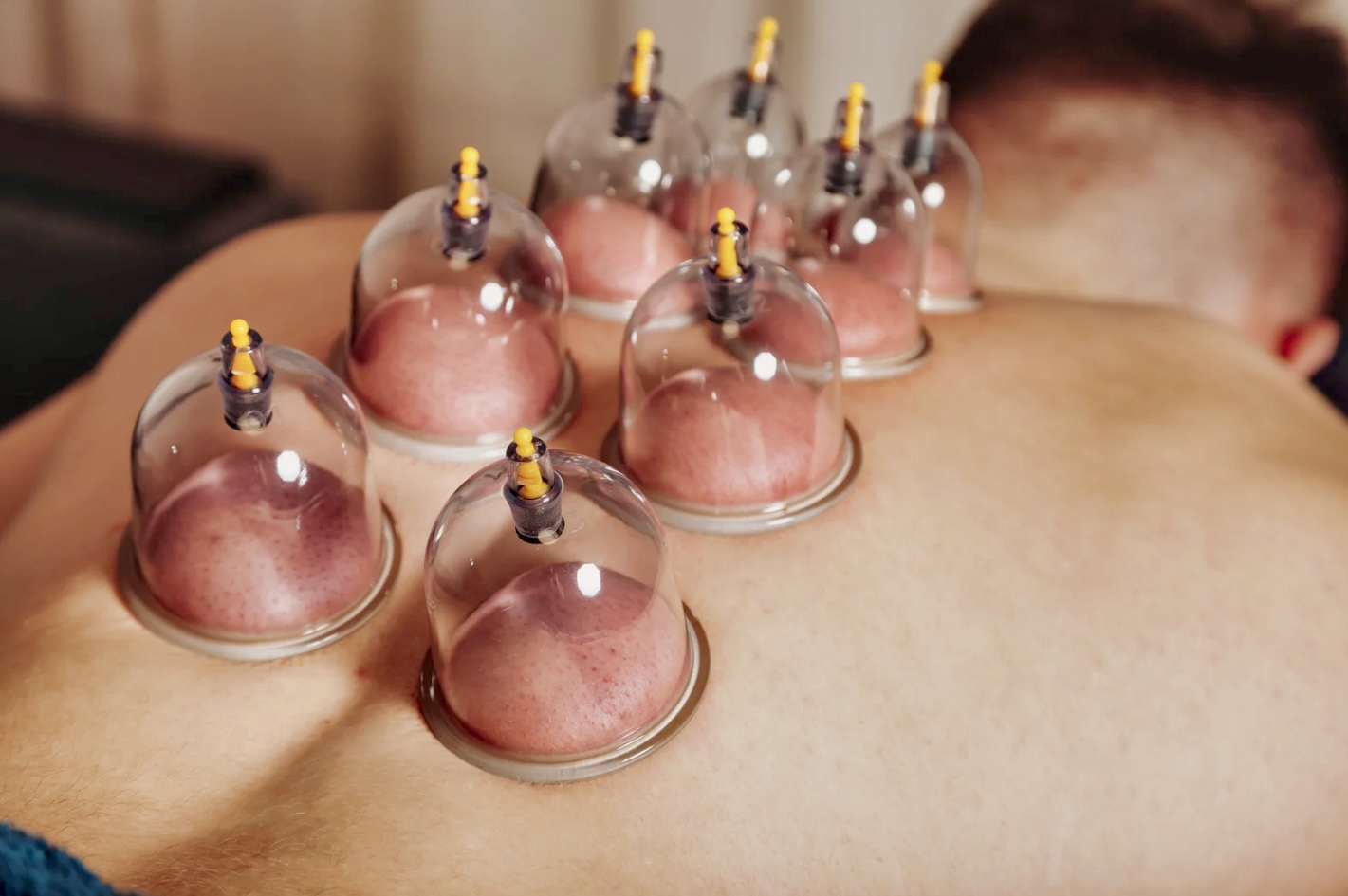 Dry Cupping Therapy